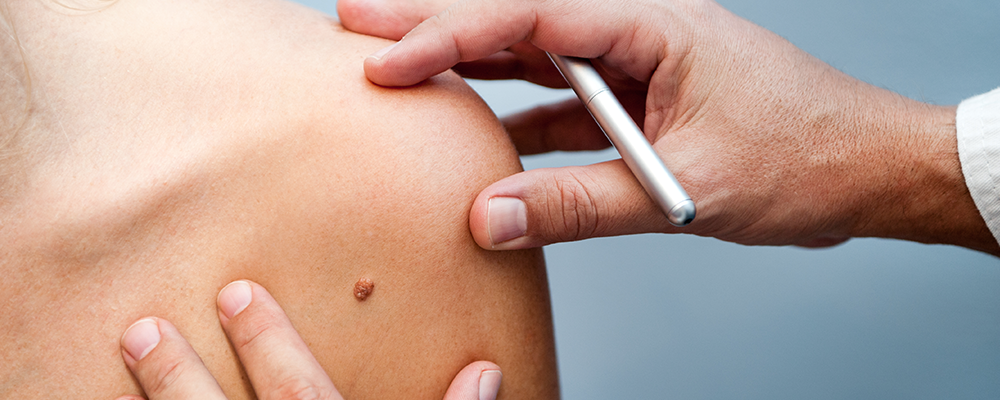 Mole Checks are available at CBD Medical